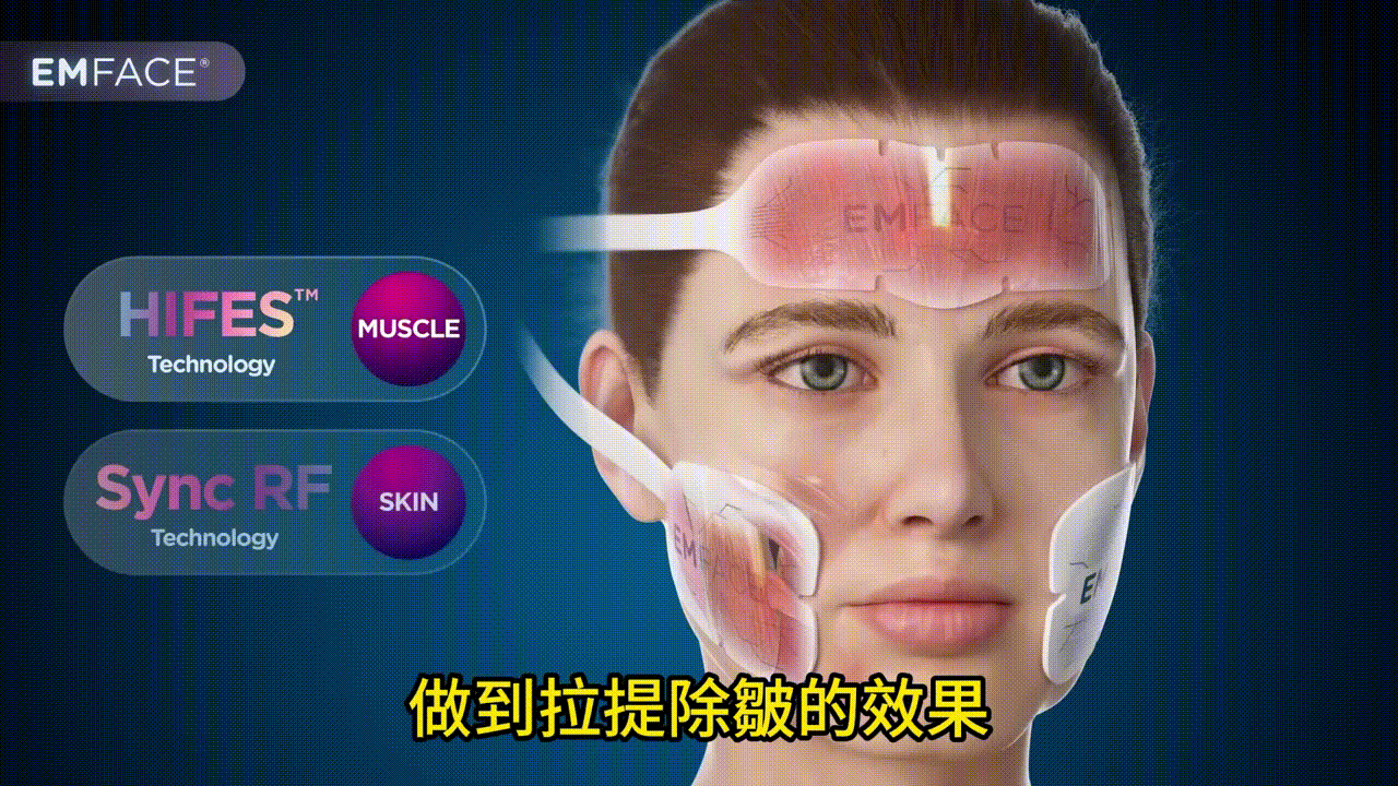 EMface是一種革命性的臉部提升儀器,結合了高強度電磁刺激(HIFES)和同步射頻(RF)技術。這兩種技術的完美結合