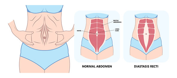 腹直肌分離(Diastasis Recti)是指腹部中央的白線(Linea Alba)因過度拉伸,導致左右兩側的腹直肌(Rectus Abdominis)分離的現象。